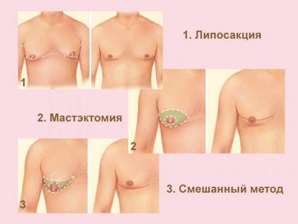 Операция по удалению гинекомастии у мужчин. Цена, как проходит