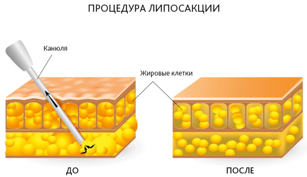 Операция по удалению гинекомастии у мужчин. Цена, как проходит