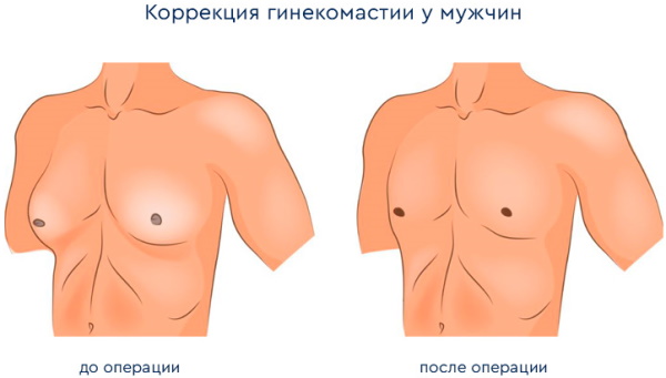 Операция по удалению гинекомастии у мужчин. Цена, как проходит
