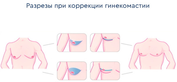 Операция по удалению гинекомастии у мужчин. Цена, как проходит