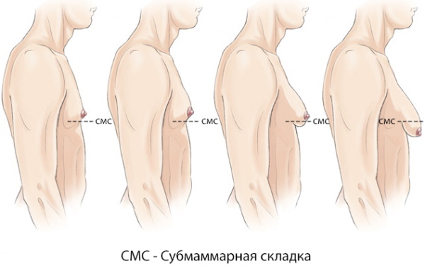 Операция по удалению гинекомастии у мужчин. Цена, как проходит