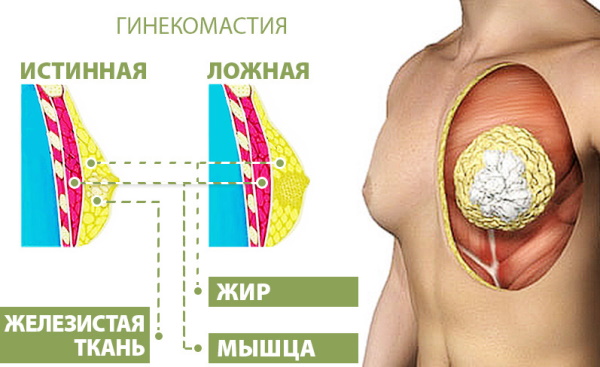 Операция по удалению гинекомастии у мужчин. Цена, как проходит