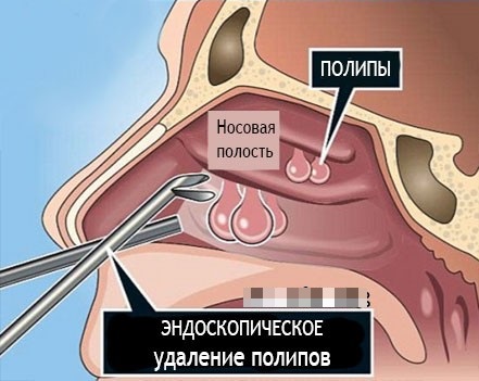 Фронтит и гайморит: разница, если одновременно, лечение