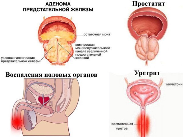 Органы малого таза у мужчин. Что входит, анатомия, МРТ, УЗИ