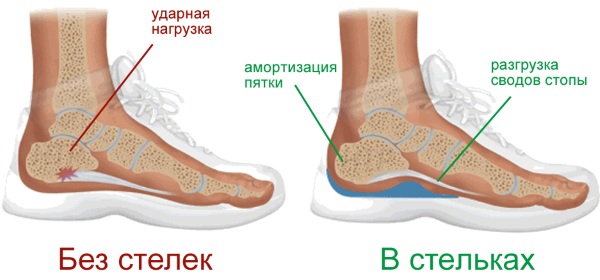 Плоскостопие. Симптомы у взрослых, степени, как определить, лечение