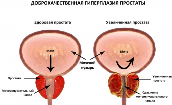 Остаточная моча у женщин, хроническая задержка. Как сходить в туалет по-маленькому