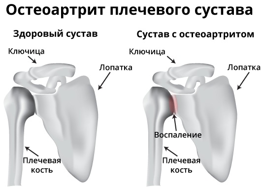 Массаж шеи и плеч. Как правильно делать в домашних условиях