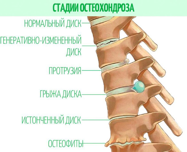 Пентоксифиллин при остеохондрозе шейного, поясничного отдела