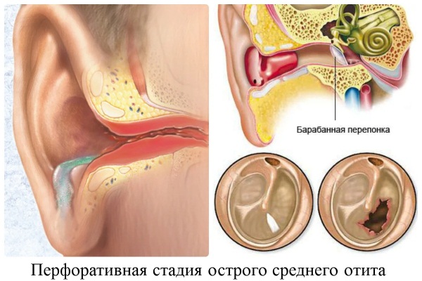 Гнойный отит у ребенка. Симптомы, лечение, капли
