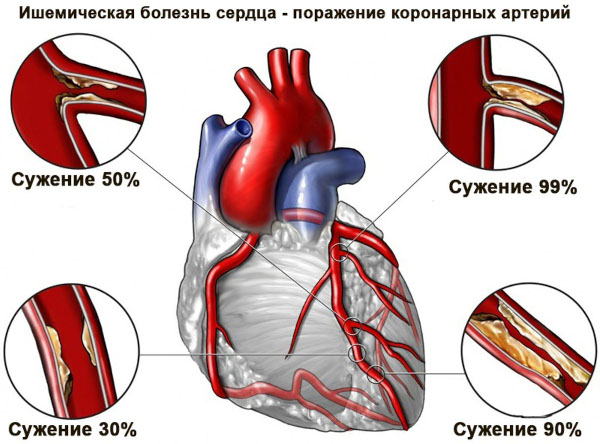 Пенно-солодковые ванны. Показания, противопоказания