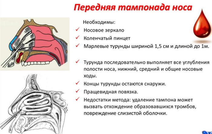 Передняя тампонада носа. Алгоритм действий, показания, как выполняется