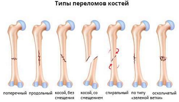 Перелом лодыжки. Реабилитация в домашних условиях после снятия гипса, лечение, период восстановления