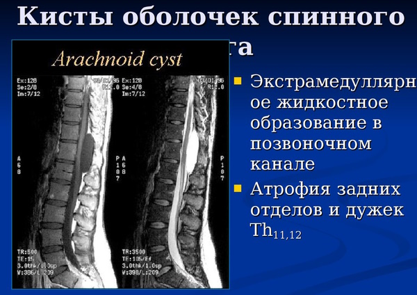 Периневральные кисты позвоночника в пояснично-крестцовом отделе
