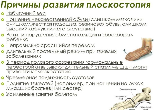 Плоскостопие. Симптомы у взрослых, степени, как определить, лечение