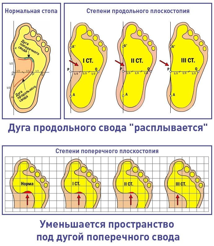 Плоскостопие. Симптомы у взрослых, степени, как определить, лечение