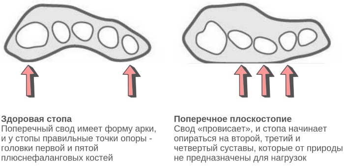 Плоскостопие. Симптомы у взрослых, степени, как определить, лечение