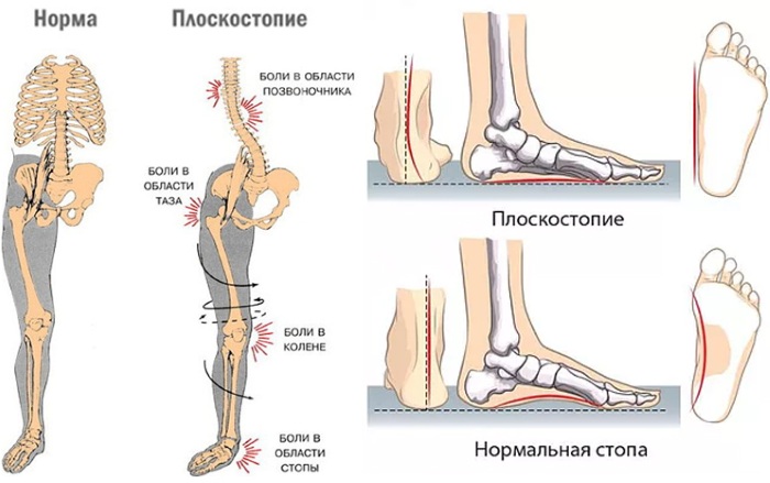 Плоскостопие. Симптомы у взрослых, степени, как определить, лечение