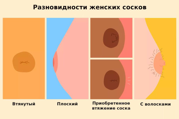Большие соски и крупные ареолы груди у девушек. Причины