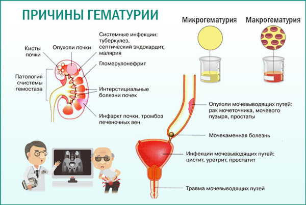 Почему моча желтая, ярко желтого лимонного цвета у женщин. Причины