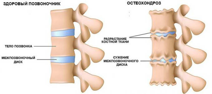 Полисегментарный остеохондроз позвоночника. Что это такое, степени