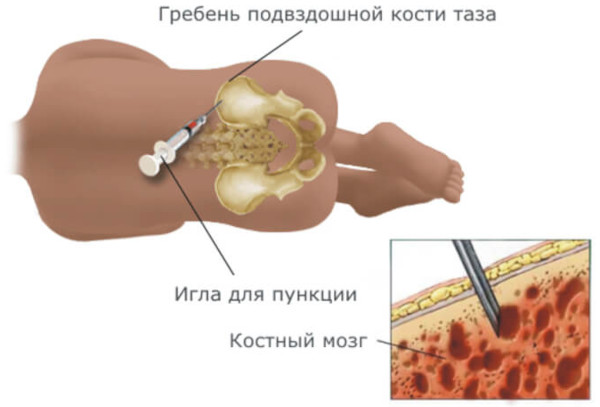 Полицитемия истинная (эритремия, болезнь Вакеза). Что это такое