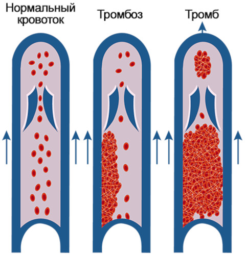 Полицитемия истинная (эритремия, болезнь Вакеза). Что это такое