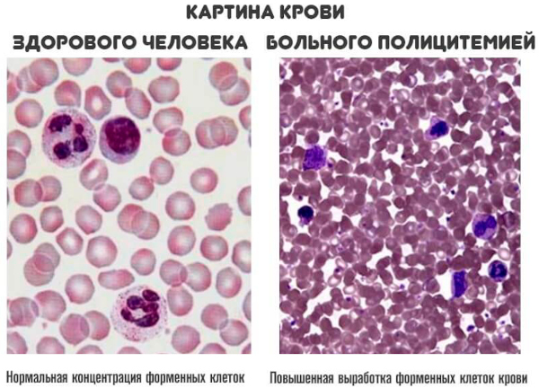 Полицитемия истинная (эритремия, болезнь Вакеза). Что это такое