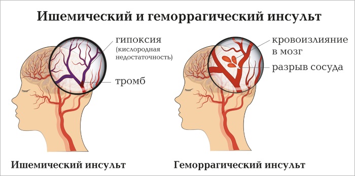 Немеет правая часть лица. Причины и лечение у взрослых