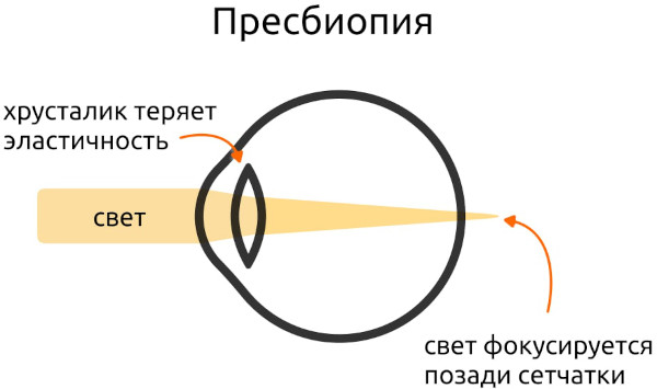 Пресбиопия глаз. Что это такое у взрослых, как лечить
