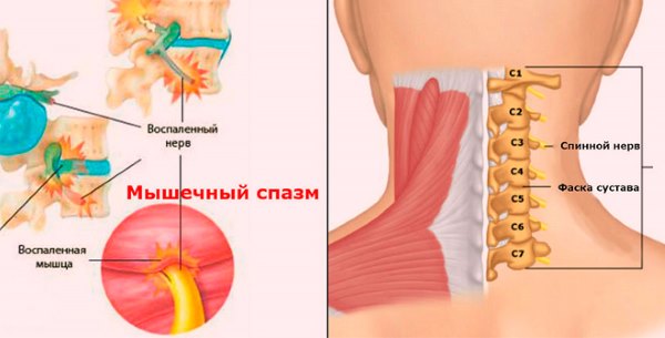 Причины болевых ощущений на шее сзади. Возможные заболевания и проблемы со здоровьем