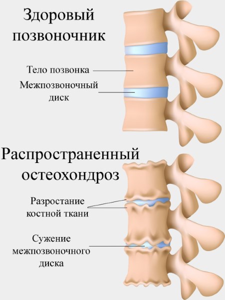 Причины боли в левом плече и предплечье. Резкая, ноющая, тупая боль и рекомендации врачей