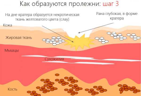 Профилактика пролежней. Что это такое, как выглядят, фото, виды