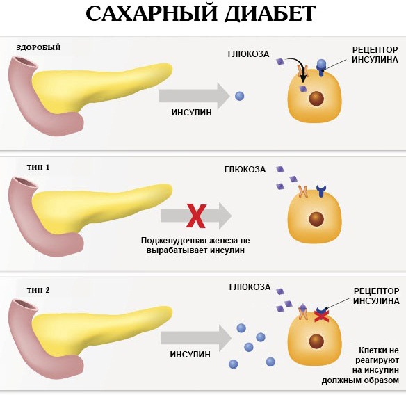 Тресиба (Tresiba) инсулин. Инструкция по применению, отзывы