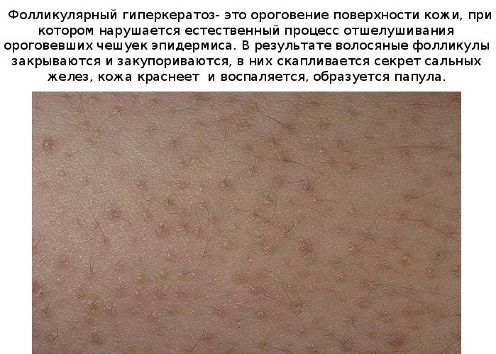 Прыщики на запястье чешутся: мелкие, водянистые, красные. Почему появились, фото