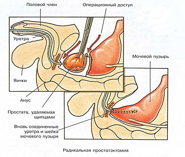 ПСА после радикальной простатэктомии. Норма, почему растет