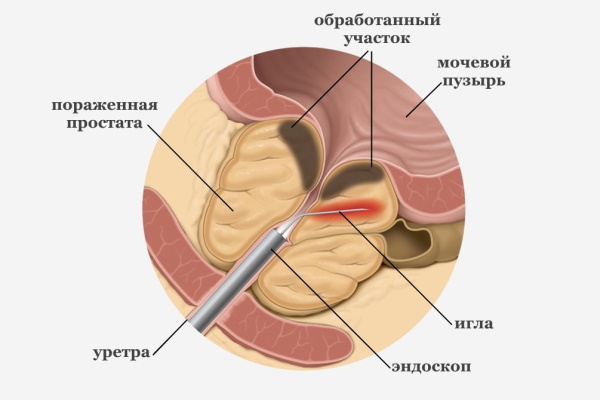 ПСА после радикальной простатэктомии. Норма, почему растет