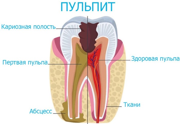 Как вылечить кариес без стоматолога у ребенка, подростка