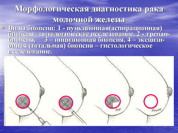 Как проводится пункция молочной железы под контролем УЗИ