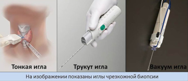 Как проводится пункция молочной железы под контролем УЗИ