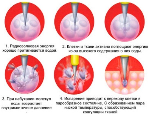 Радиоволновое удаление новообразований кожи, дефектов. Что это такое