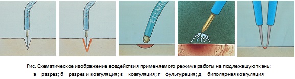 Радиоволновое удаление новообразований кожи, дефектов. Что это такое