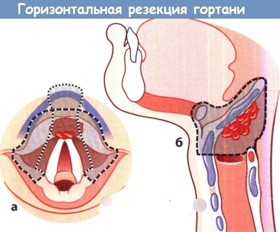 Рак гортани. Симптомы, фото, лечение