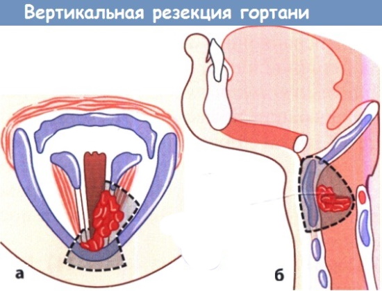 Рак гортани. Симптомы, фото, лечение