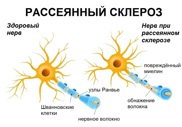 Шаткость (шаткая походка). Причины, лечение в пожилом возрасте