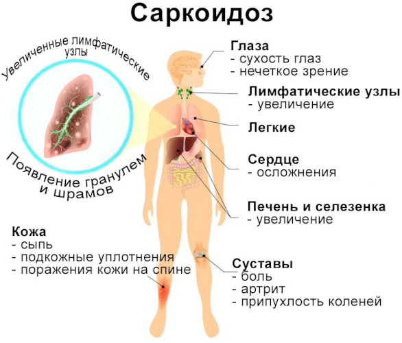 Саркоидоз легких. Что это за болезнь, прогноз