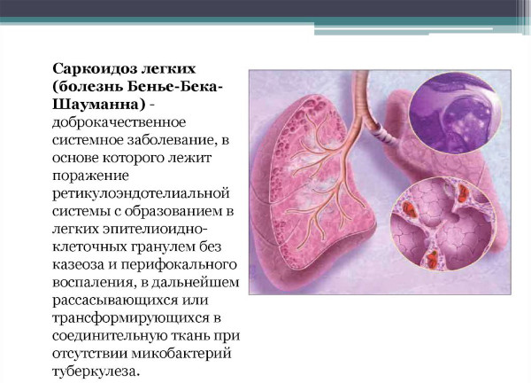 Саркоидоз легких. Что это за болезнь, прогноз
