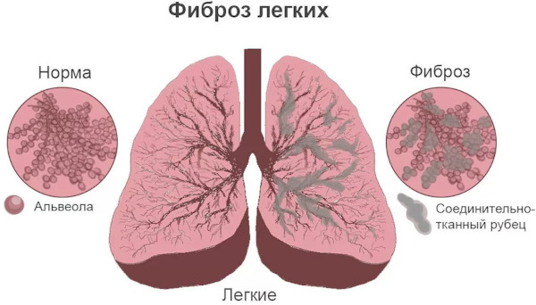 Саркоидоз легких. Что это за болезнь, прогноз