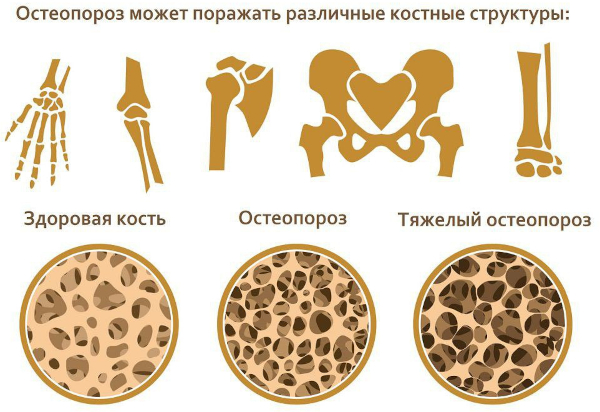 Саркоидоз легких. Что это за болезнь, прогноз