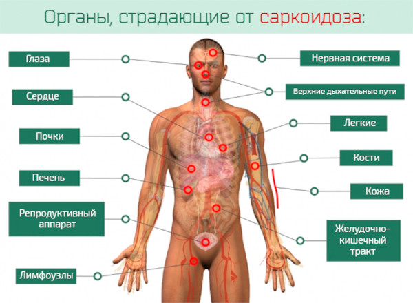 Саркоидоз легких. Что это за болезнь, прогноз