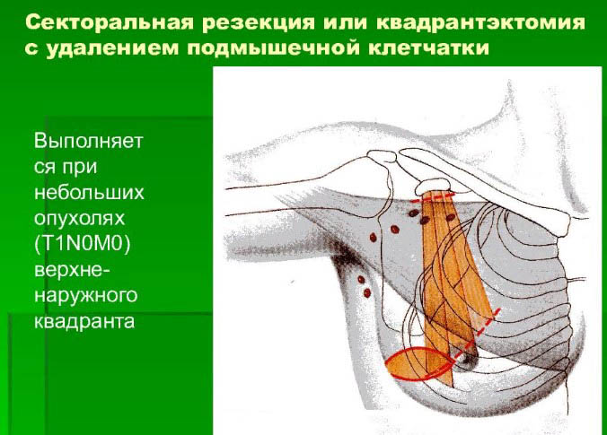 Секторальная резекция молочной железы. Что это такое, восстановление